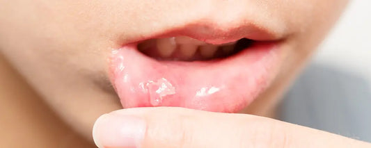 Soothing Smiles: Caring for Baby's Mouth Ulcers